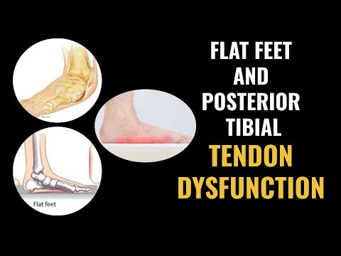 Flat Feet and Posterior Tibial Tendon Dysfunction