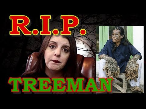 10 People With Shocking and Extreme Deformities - Listverse