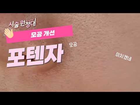 모공이 아주 고민이면 드루와