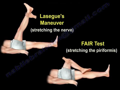Piriformis Test, piriformis syndrome