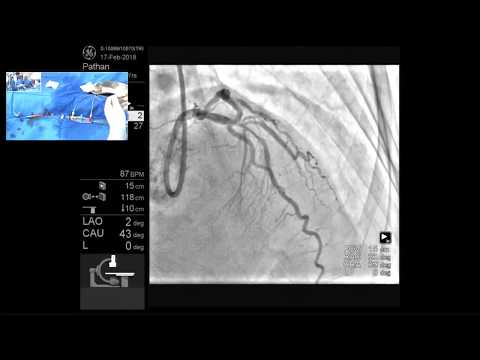 PCI of LAD-D1 Bifurcation & OCT evaluation