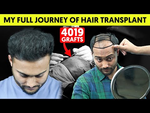 Hair Transplant Full Journey with 4019 Grafts || Hair...