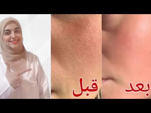 الحل النهائى للتخلص من المسام الواسعة في ٣ أيام فقط.. هنا hana