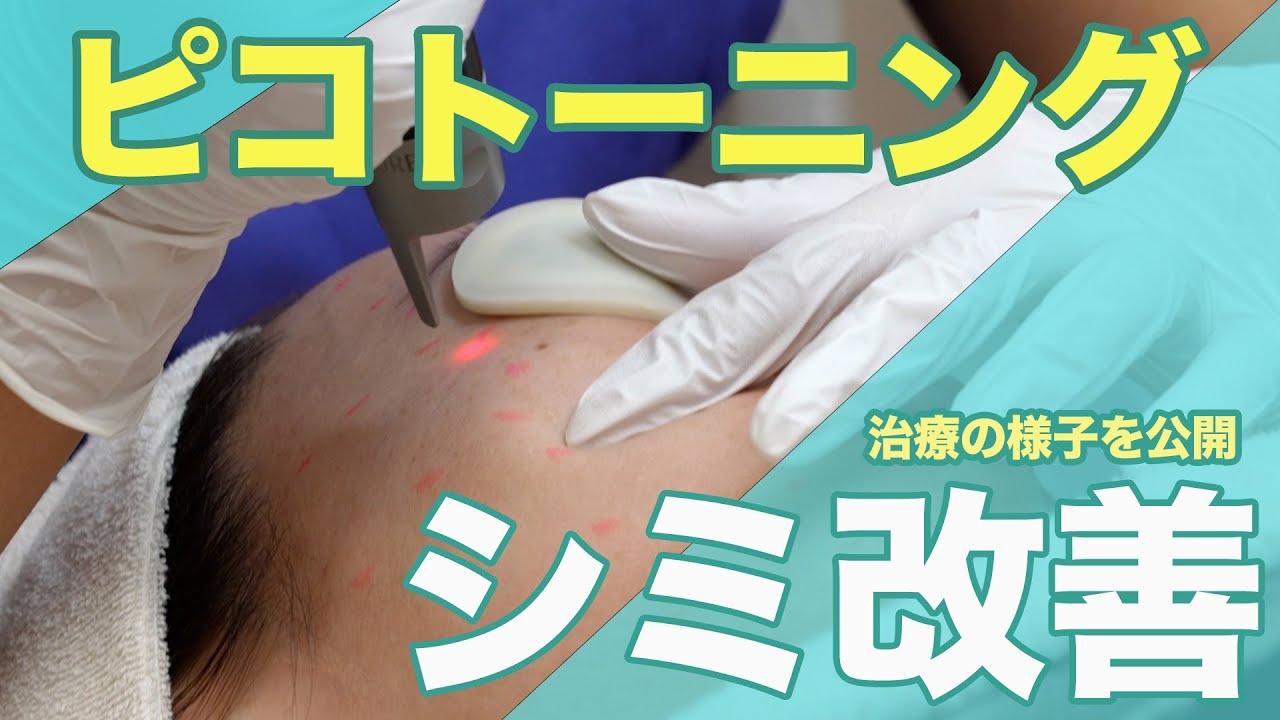 【施術動画】本気のシミ治療！ピコトーニングの効果