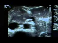 Ultrasound of the Pancreas
