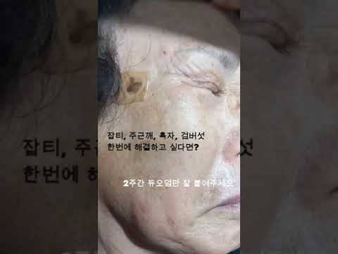 잡티 주근깨 흑자 검버섯 제거 썸네일
