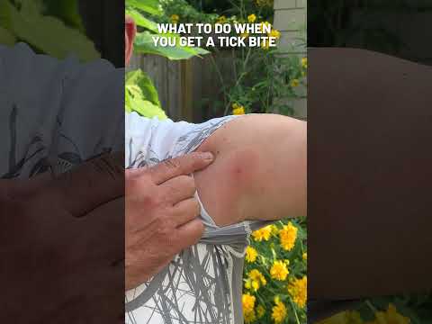 What To Do When You Get a Tick Bite | Ranger Ready Repellents