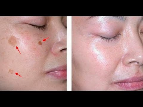 Веснушки на ушах шиншиллы Пигментные пятна на лице как избавиться на руках