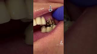 Removing … OLD Dental Bridge