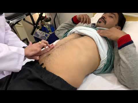 Ascites examination | Liver | Dr Arvind Kumar