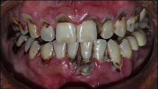 Scaling Treatment || Teeth scaling and Root Planing procedure #DeepCleaning