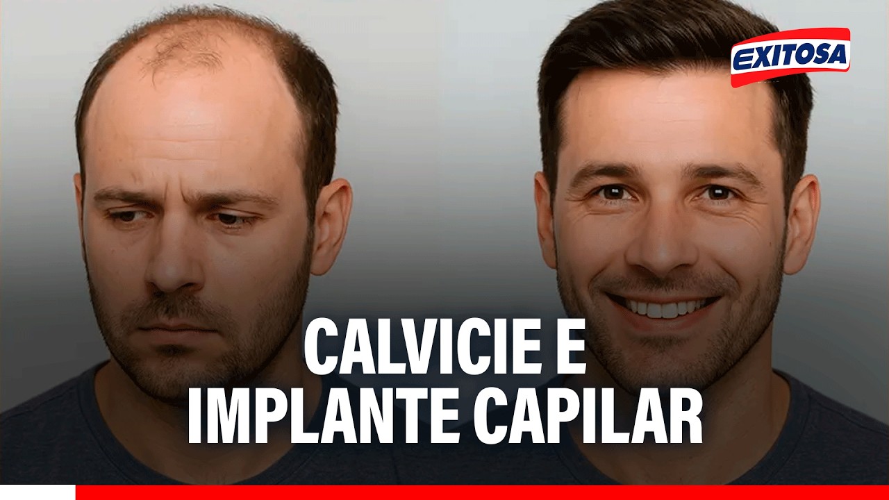 🔴🔵 Calvicie e implante capilar: "Hay tres tipos de caída de cabello"
