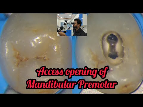 Access opening of Mandibular Premolar step by step demonstration #Rct for beginners #dental lectures