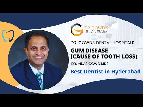 Best Dentist In Hyderabad | Cosmetic Dentist In Hyderabad | Dental Specialist Result - Dr. Gowds