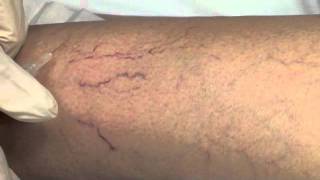 Spider Vein Sclerotherapy