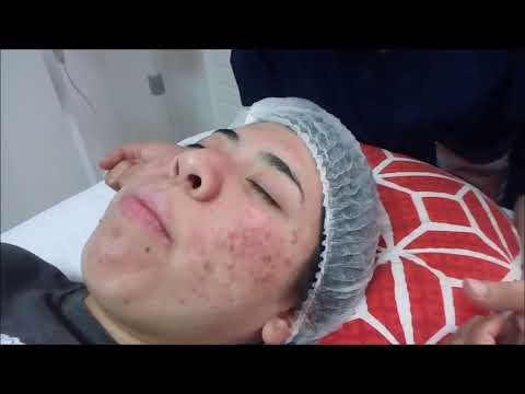 A causa di quello che cè su una faccia pigmentary posti A gravidanza su una faccia il pigmentary nota su