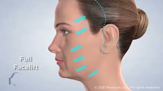 Facelift