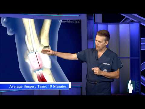 De Quervain's (Stenosing Tenosynovitis) Surgery