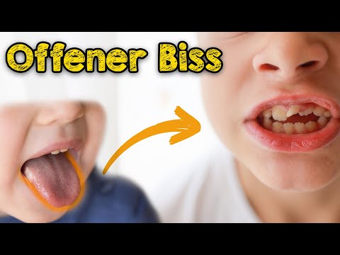 Offener Biss: Von Ursachen bis Lösungen