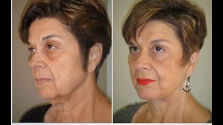 Choosing the RIGHT Facelift - How to Decide?