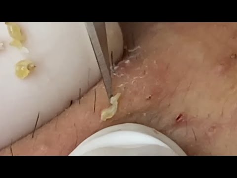 Soothing ASMR Blackhead Removal: Relaxation and Clear Skin