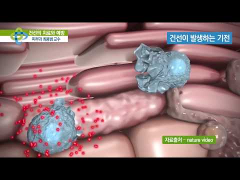 건선의 치료와 예방