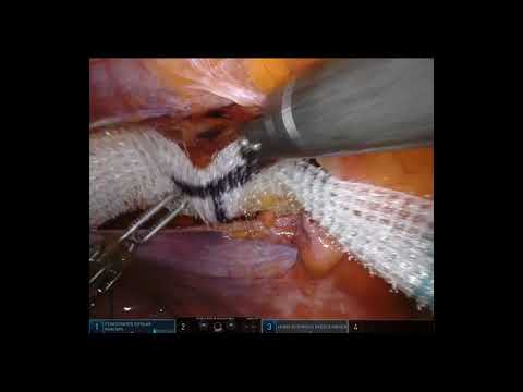 Laparoscopic Repair of Femoral Hernia - Colorectal and Gastro