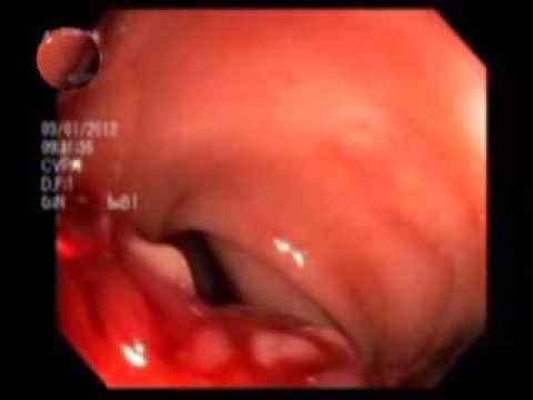 Adénocarcinome du côlon