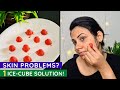 Acne Dark Spots Open Pores 1 ICE CUBE SOLUTION Malayalam Keerthi S Katalog