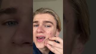 How to cover your acne as a guy