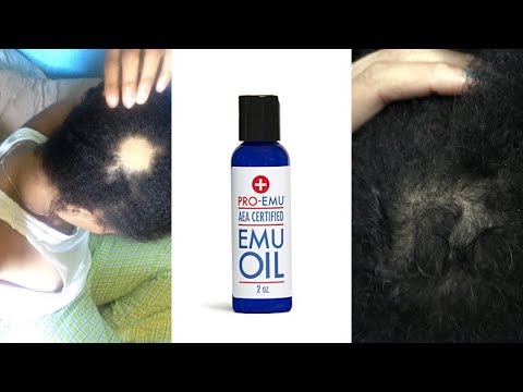 Emu Oil For Hair Growth?