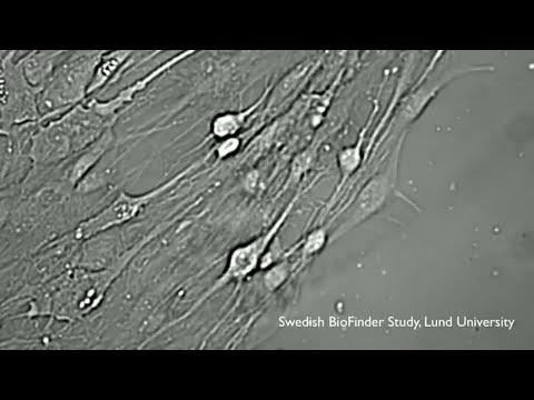 Botmedel mot fruktade Alzheimers sjukdom allt närmre - Sofia fick diagons som 41-åring - Nyheterna (