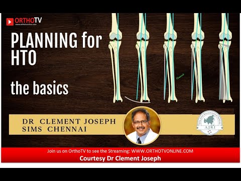 High tibial osteotomy planning - Get your HTO right ! Dr Clement Joseph