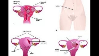 Fibroid in Uterus (Myoma) : What is a Fibroid, Causes, Types, Symptoms and Fibroid Treatment.