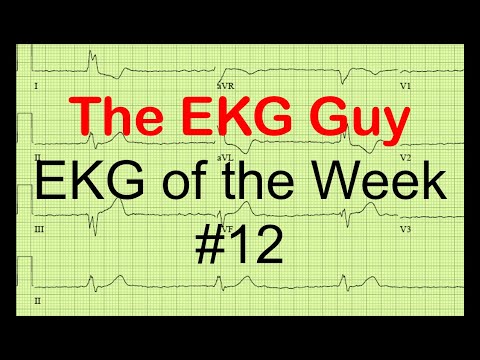 EKG/ECG of the Week #12 | The EKG Guy - www.ekg.md