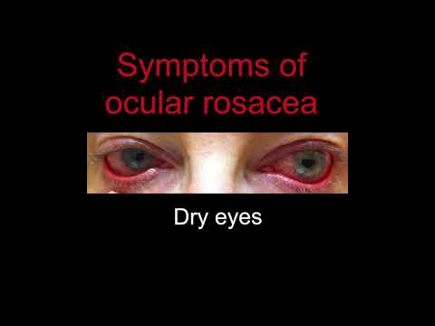 Ocular Rosacea