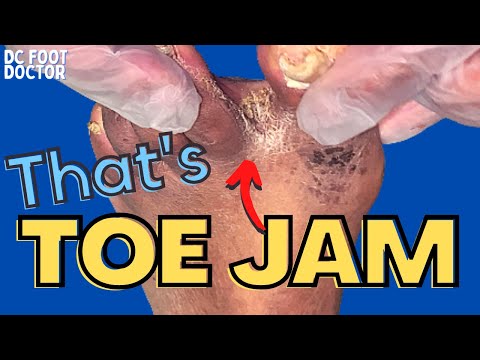 That's Toe Jam! The Build-up Between Toes Explained, Trimming Of Fungal Toenails, and Skin Scales