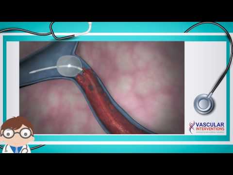 Deep Vein Thrombosis Treatment using Trellis Procedure