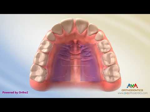 Orthodontic Expander or Spacer - Dynaflex Appliance