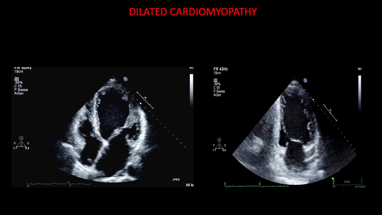 Echocardiography in dilated cardiomyopathy