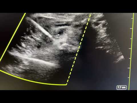 Ultrasound guided Lumbar facet joint injection