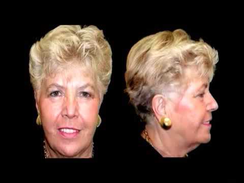 Nobel Biocare Implants