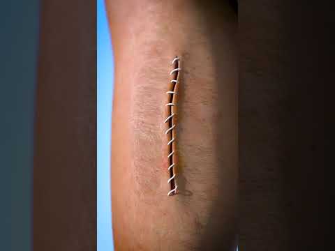 How Stitches Work 😯