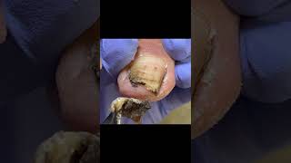 Black dirt was hidden under his very long toenails! #nails  #pedicure