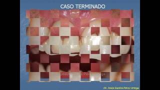 ESTETICA DENTAL Implante Inmediato post-extraccion, Dr Jesús Santos Pérez Ortega