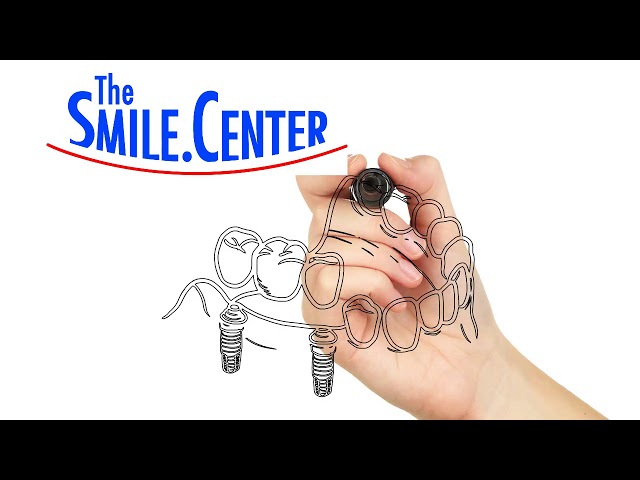 Create a Stronger Smile With Dental Implants