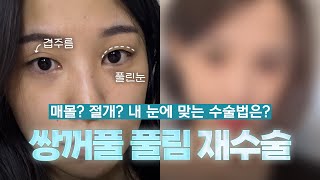 두 번 풀린 쌍꺼풀은 이렇게 수술해야 합니다 (ft. 마인드성형외과 - 정민경 원장님)
