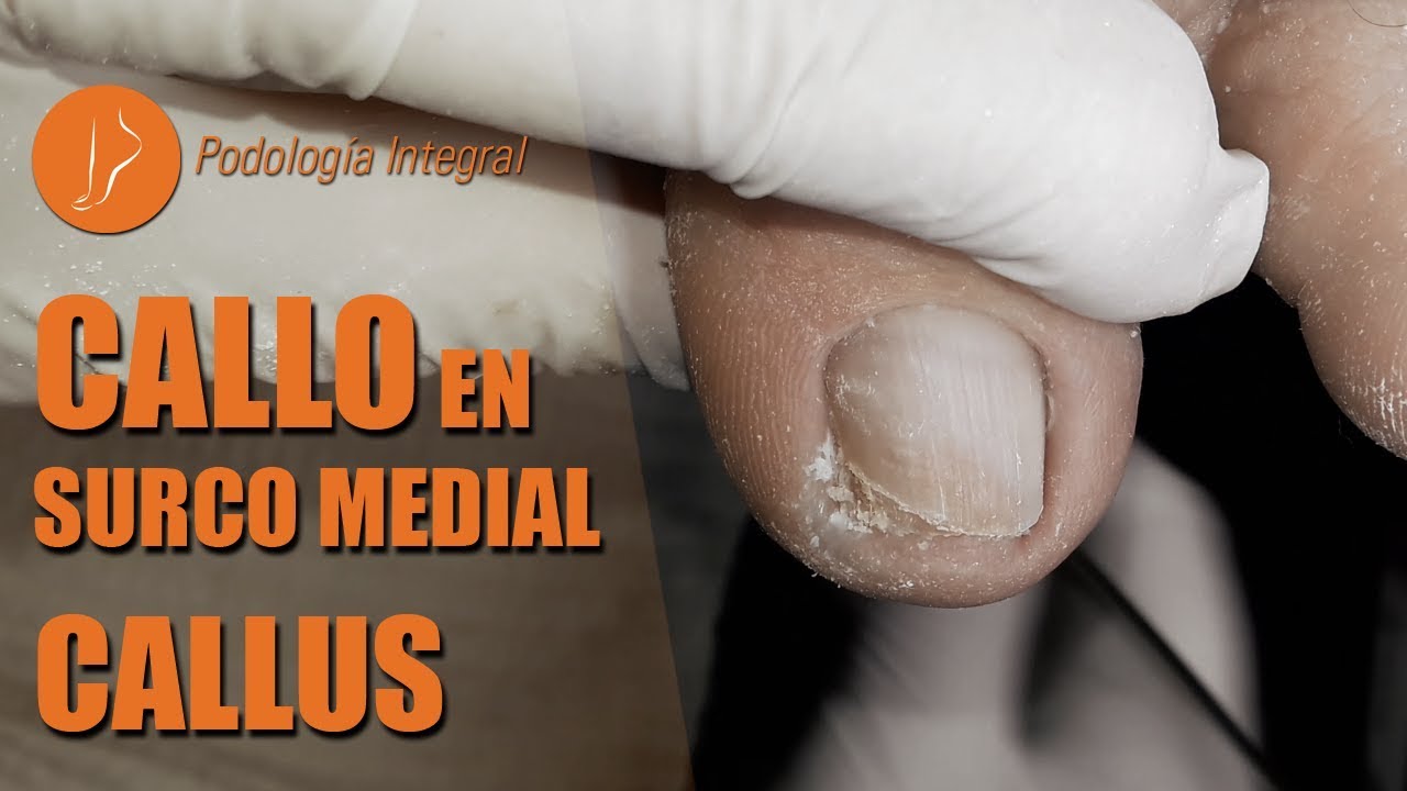Callo en surco medial | 1er video #podologiaintegral
