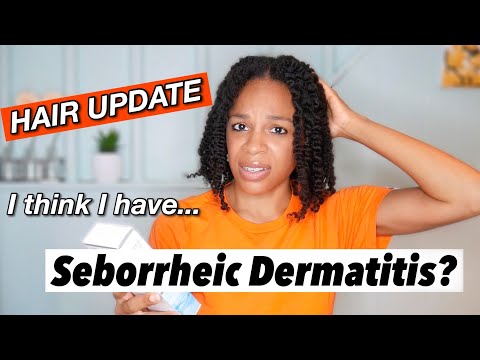 I think I have Seborrheic Dermatitis // honest hair update// what I’m using to treat it
