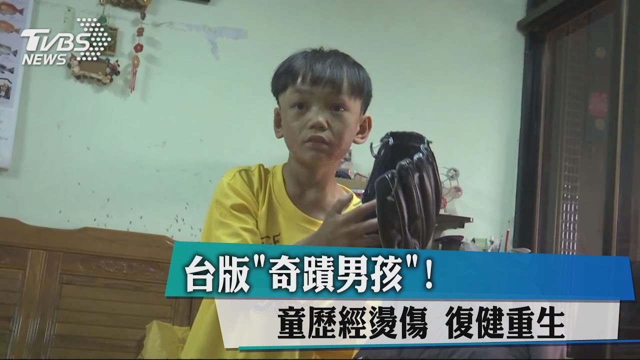 台版《奇蹟男孩》!童歷經燙傷 復健重生